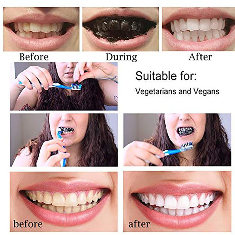 Blanqueamiento Dental con Carbón Activado.
